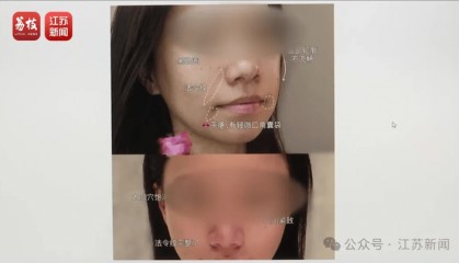 打一针“返老还童”的童颜针卖了30亿，真的有效吗？